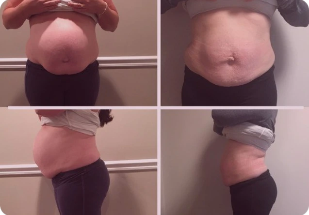Diastasis Recti before and after