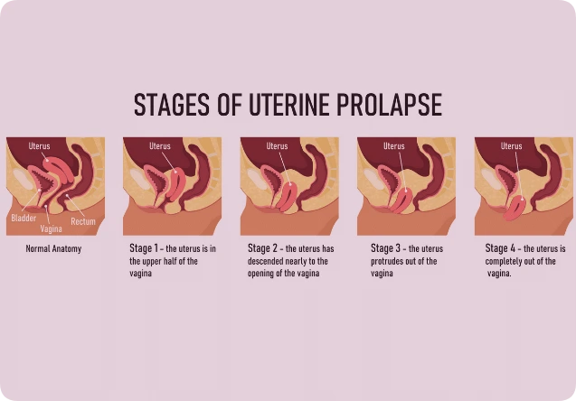 stages pf pelvic organ prolapse graphic