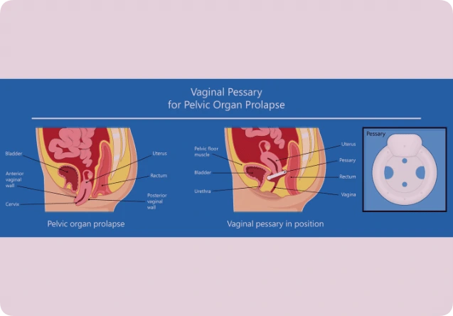 pelvic organ prolapse graphic 2