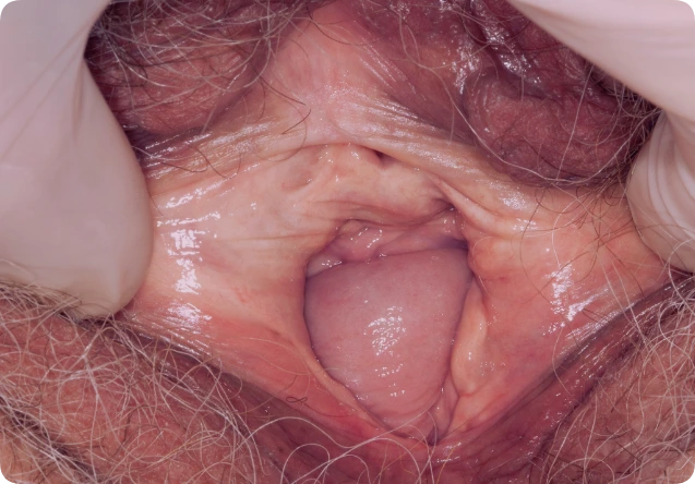vaginal prolapse photo