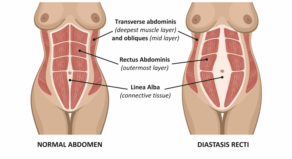 Where Diastasis Recti occurs